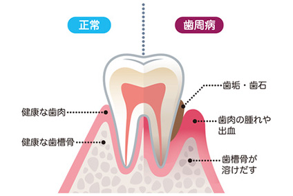 予防・歯周病治療