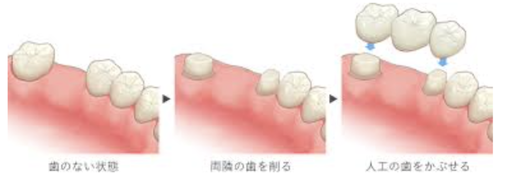 歯がなくなってしまったら　　一般的な治療方法のご紹介