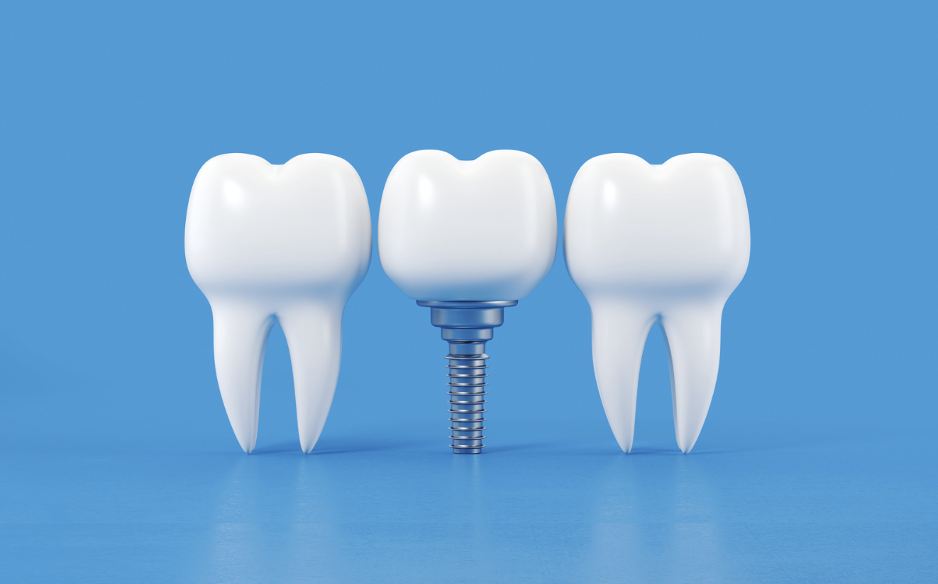 インプラントと天然歯の違いとは？メンテナンス方法の違いも解説