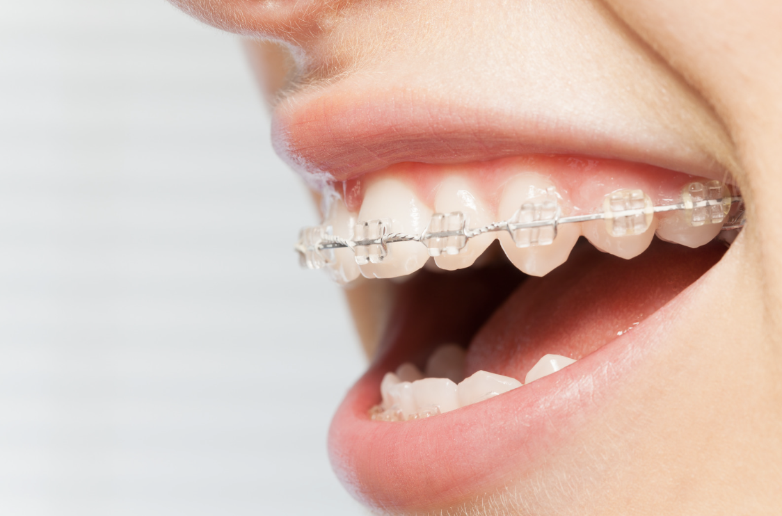 大人の矯正治療、始めるベストタイミングはいつ？年齢別のメリット